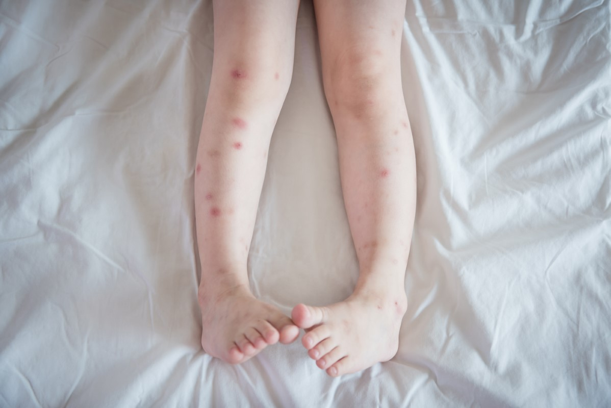 Niña con las piernas llenas de picaduras de mosquitos tumbada en la cama